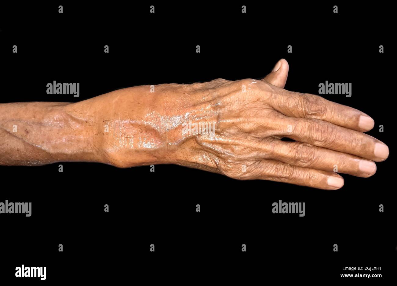 Inflammation of Asian old man’s wrist joint and hand. Concept of joint pain and hand problems