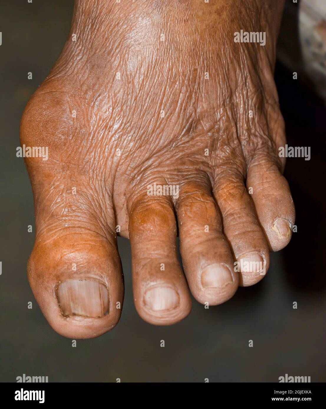 Inflammation of foot joints. Concept of foot joint pain, rheumatoid