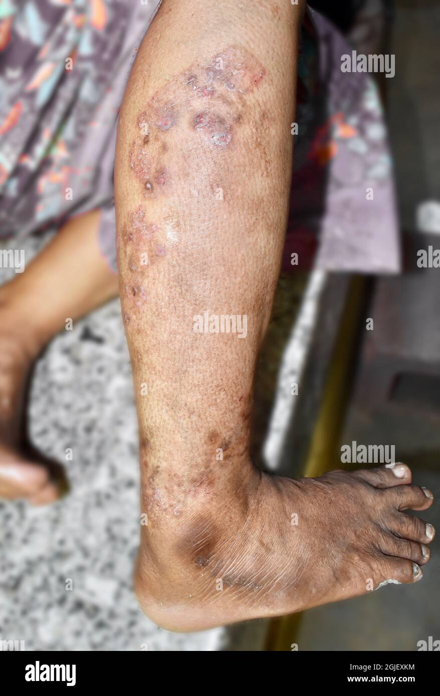 Fungal infection called tinea corporis in leg of Asian woman. Widespread ringworm over lower limb. Stock Photo