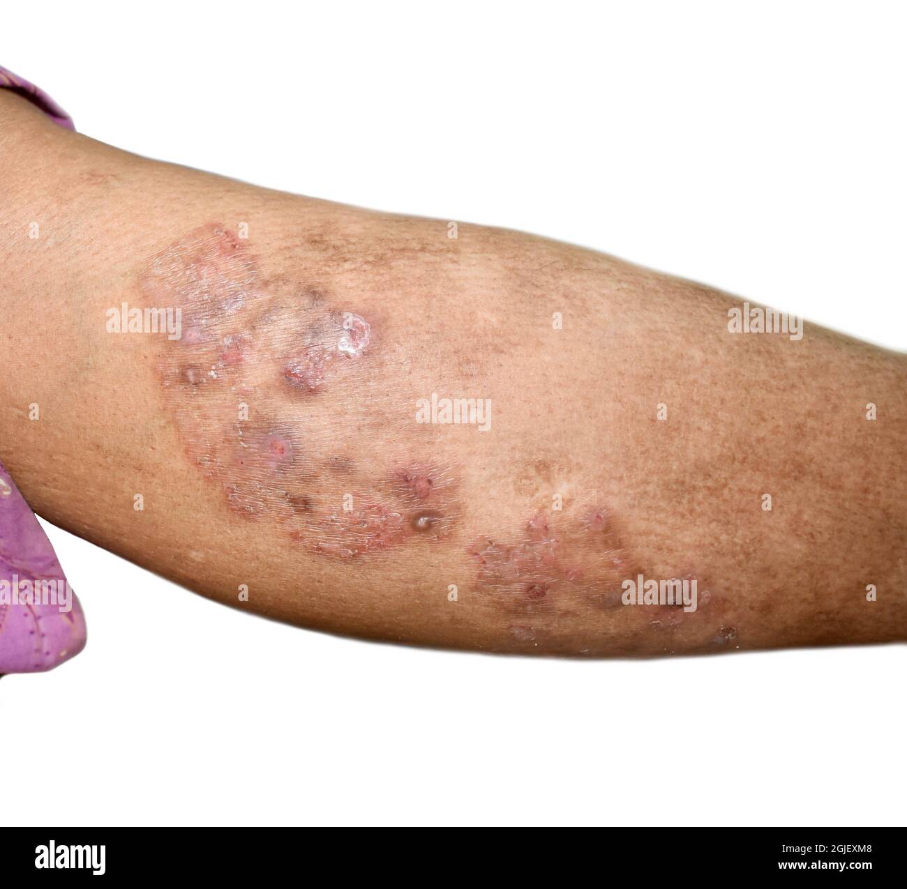 Fungal Infection Called Tinea Corporis in Leg. Widespread Ringworm Over  Knee Area Stock Photo - Image of dermatitis, lesion: 229678202