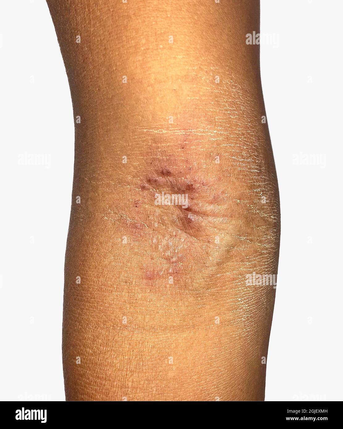Itching skin lesions on upper limb of Asian child. Stock Photo