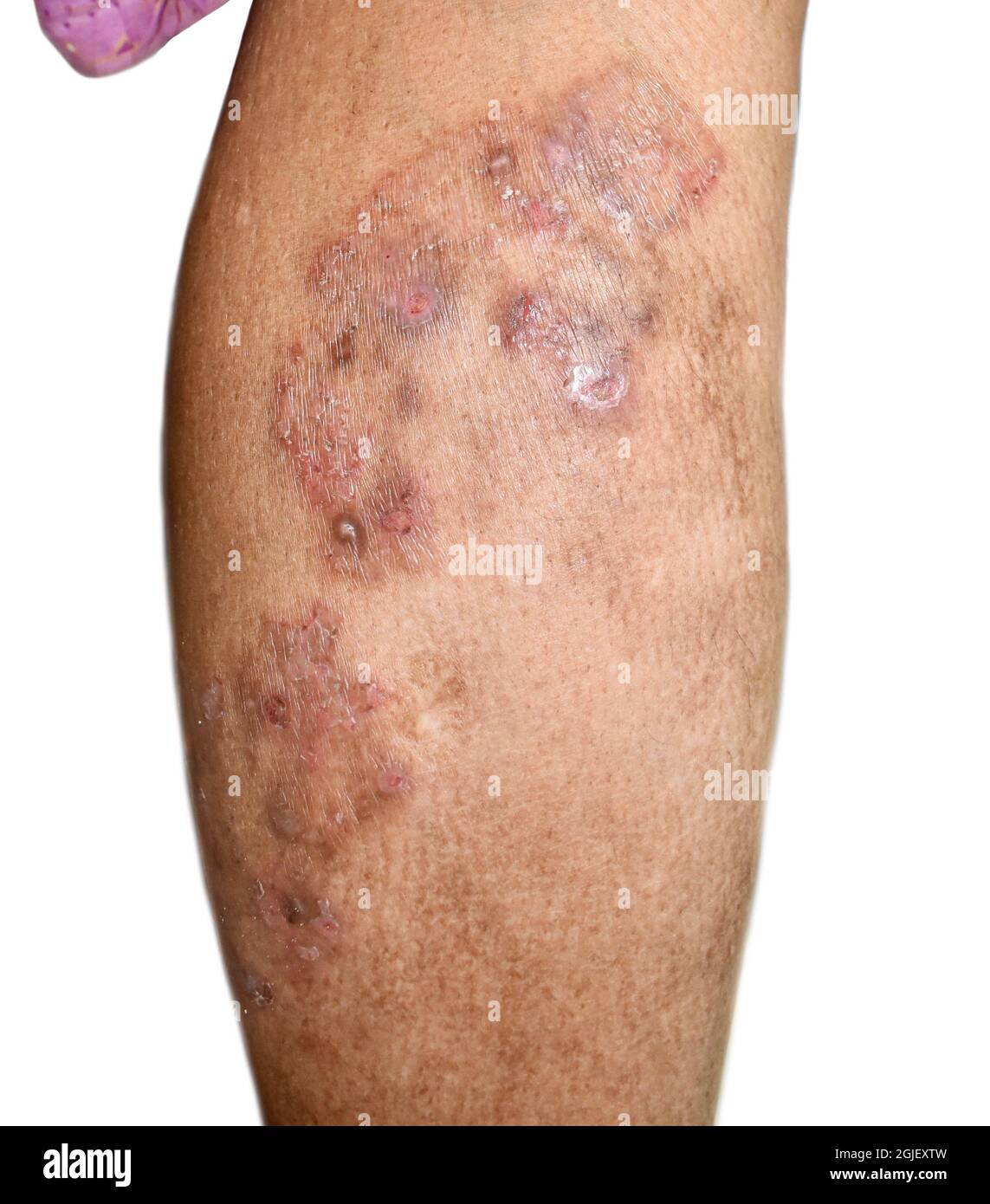 Fungal infection called tinea corporis in leg of Asian woman. Widespread ringworm over lower limb. Stock Photo