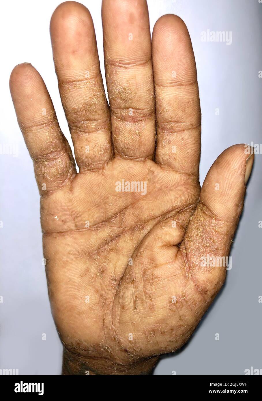 Giant scabies Infestation or Norwegian scabies in hand of Southeast Asian, Burmese man. A contagious skin condition caused by mites. Stock Photo
