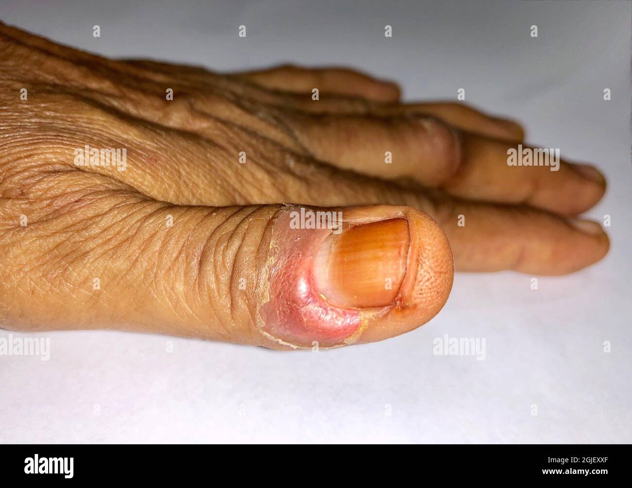 Paronychia at thumb of Asian eldely woman. It is painful lesion. Stock Photo