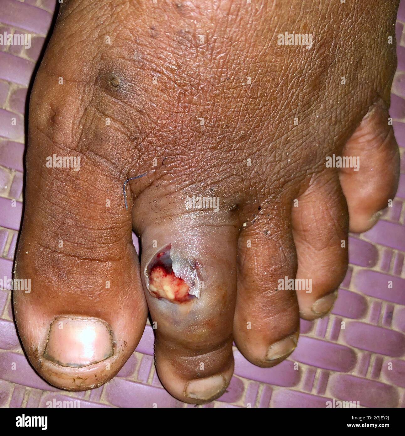 Cellulitis and foot hi-res stock photography and images - Alamy