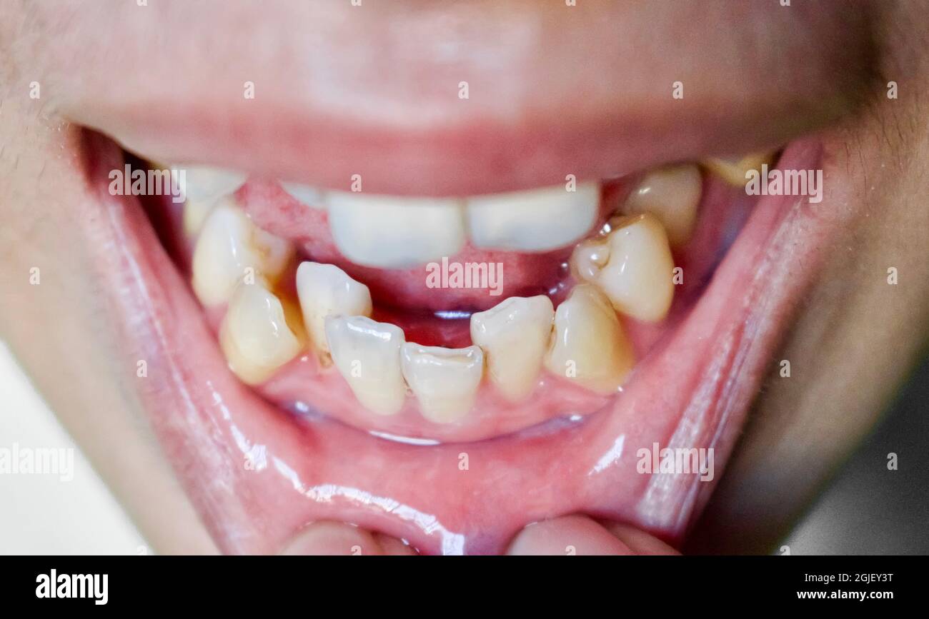 worlds ugliest teeth