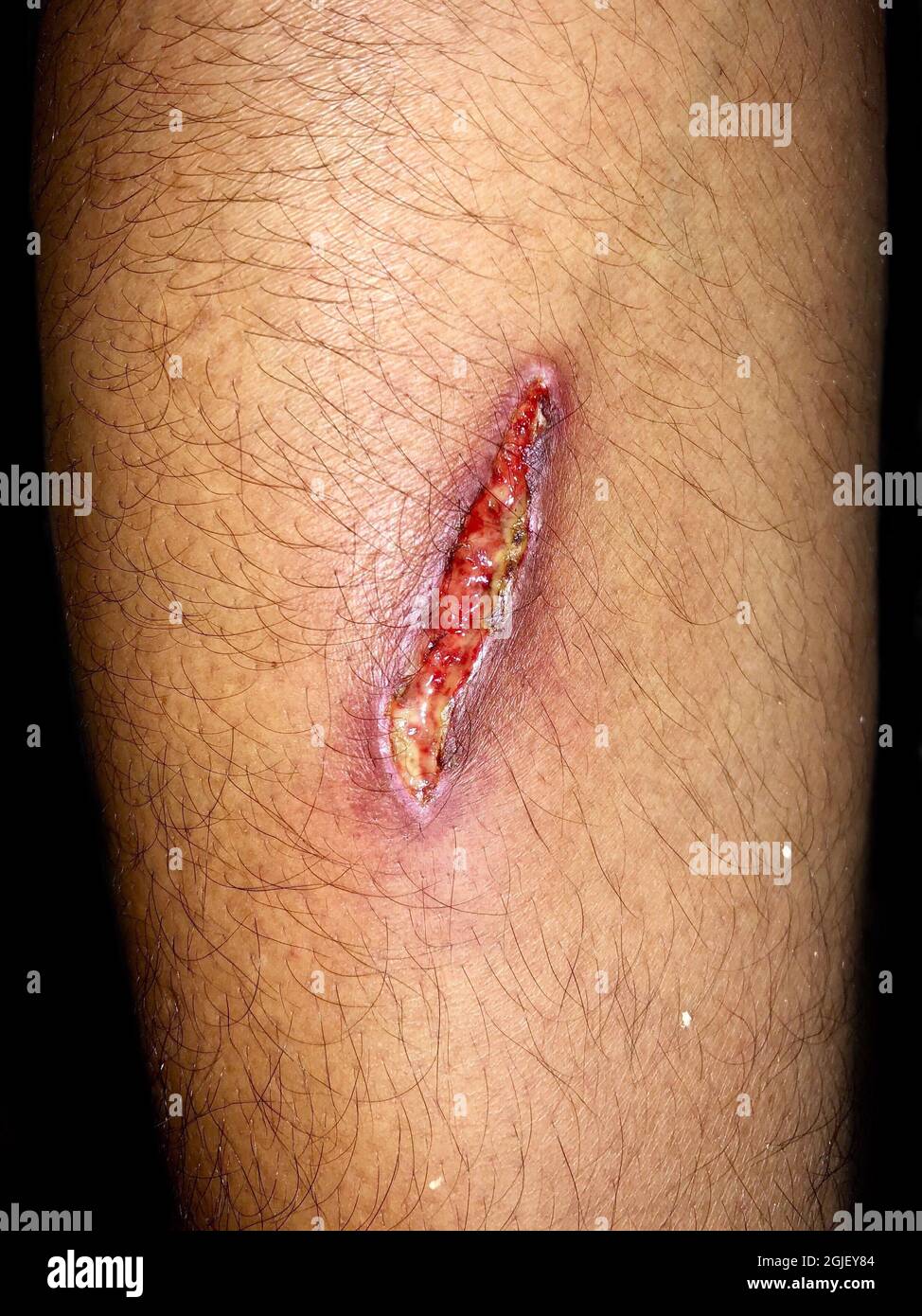 Poor wound healing or secondary wound healing with large wound gapping. Wound infection. Isolated on black. Stock Photo