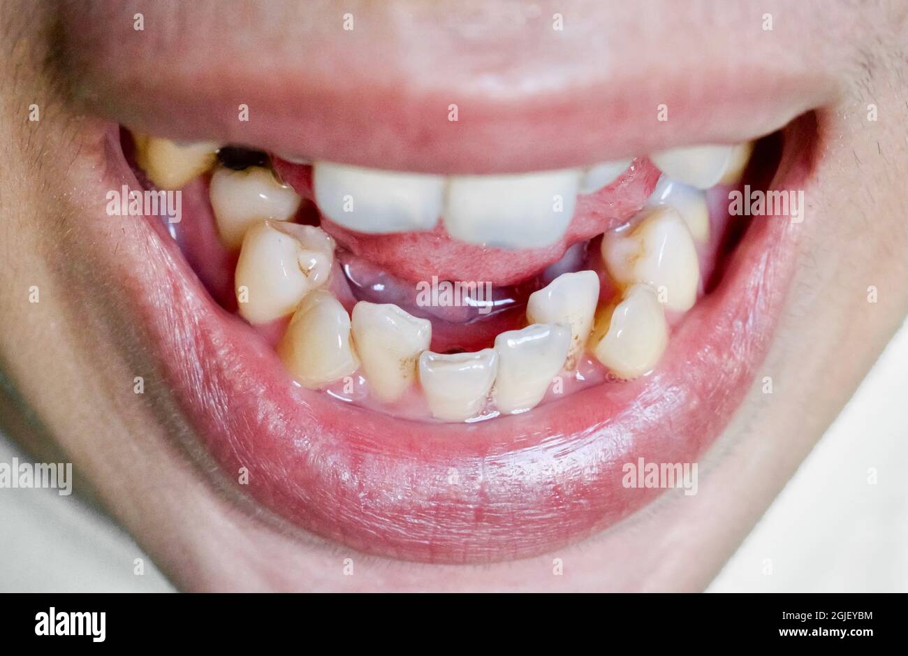 Stacked or overlapping teeth of Asian man. Also called crowded teeth. Closeup view. Stock Photo