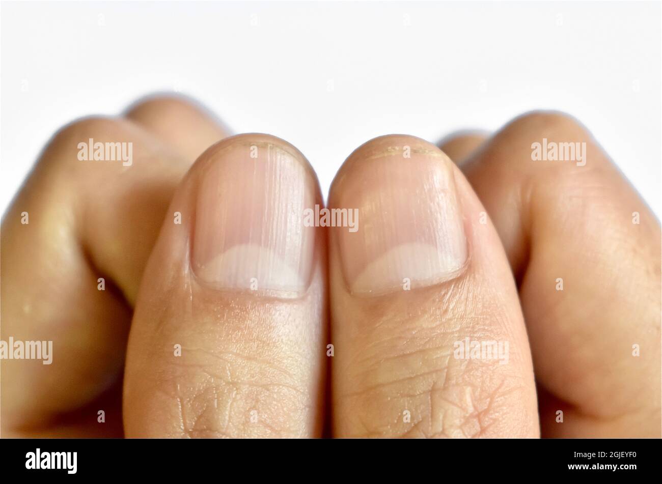 Large lunulae or half-moons at fingernails with longitudinal lines of Southeast Asian, Chinese young man. Isolated on white background Stock Photo - Alamy Large lunulae or half-moons at fingernails with longitudinal lines of Southeast Asian, Chinese young man. Isolated on white background Stock Photo - Alamy