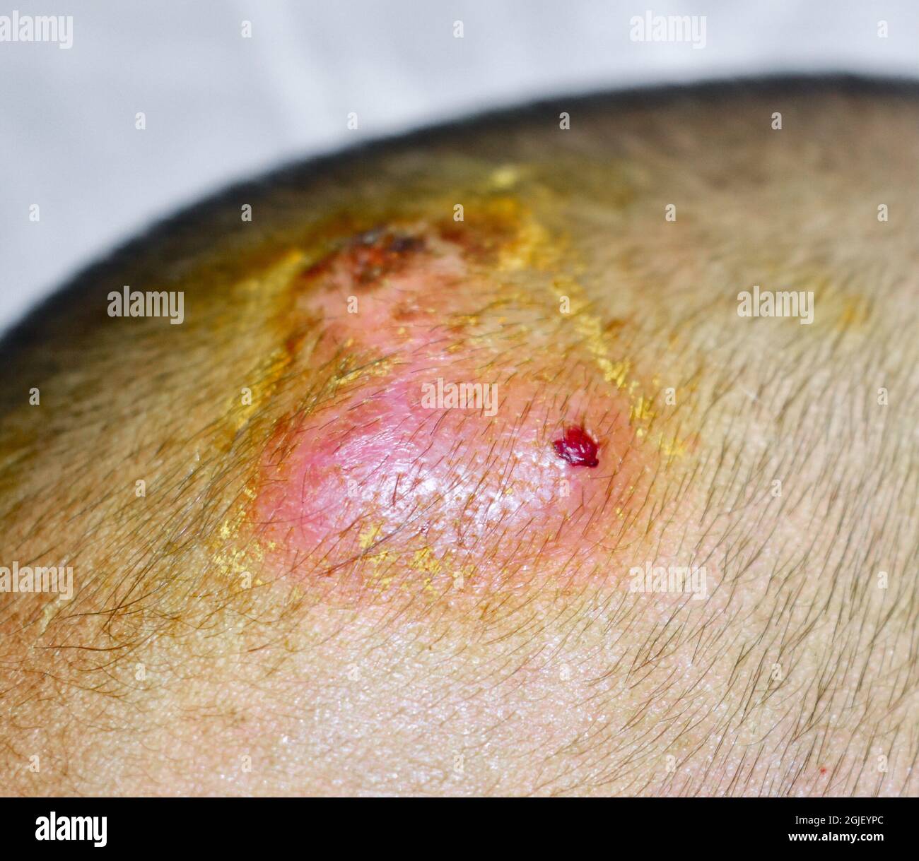 Carbuncles or staphylococcal infection in head of Asian child. Painful skin lesions.  Closeup view. Stock Photo