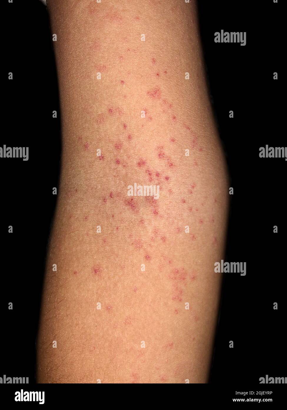 Multiple red spots in cubital fossa showing that Hess’s test positive. Dengue hemorrhagic fever. Stock Photo