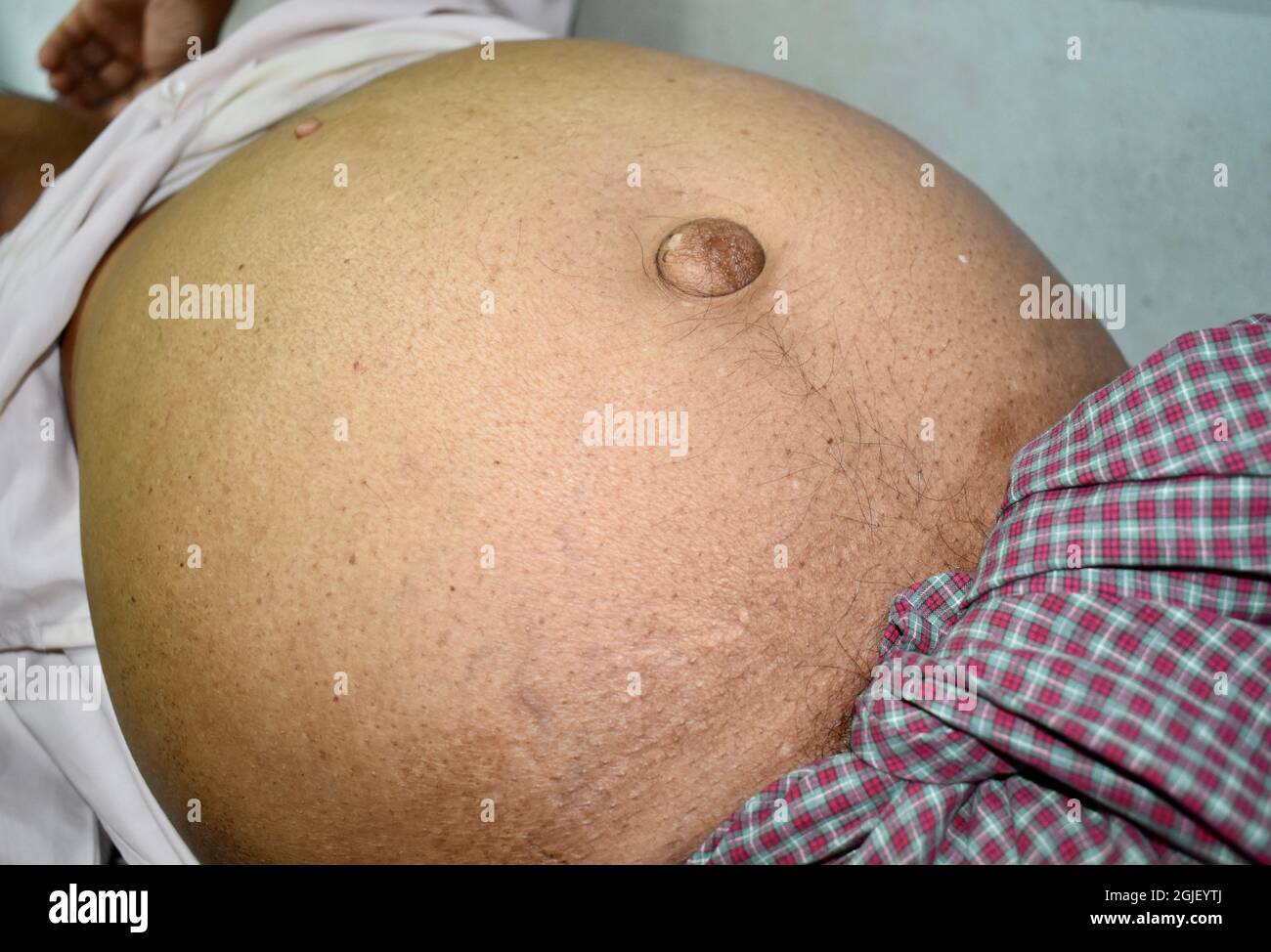 Abdominal fat in patient with ascities and paraumbilical hernia. Flank is full. Right lower view. Stock Photo