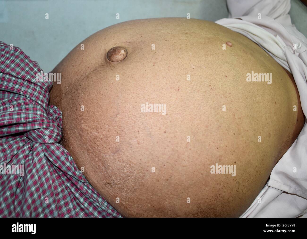 Abdominal fat in patient with ascities and paraumbilical hernia. Flank is full. Left lower view. Stock Photo