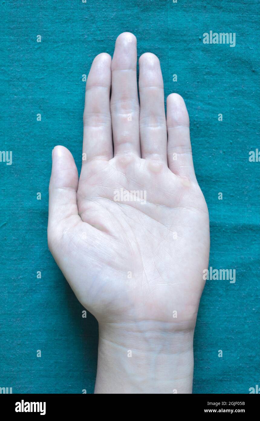 Pale palmar surface of hand. Anaemic hand of Asian, Chinese man. Stock Photo