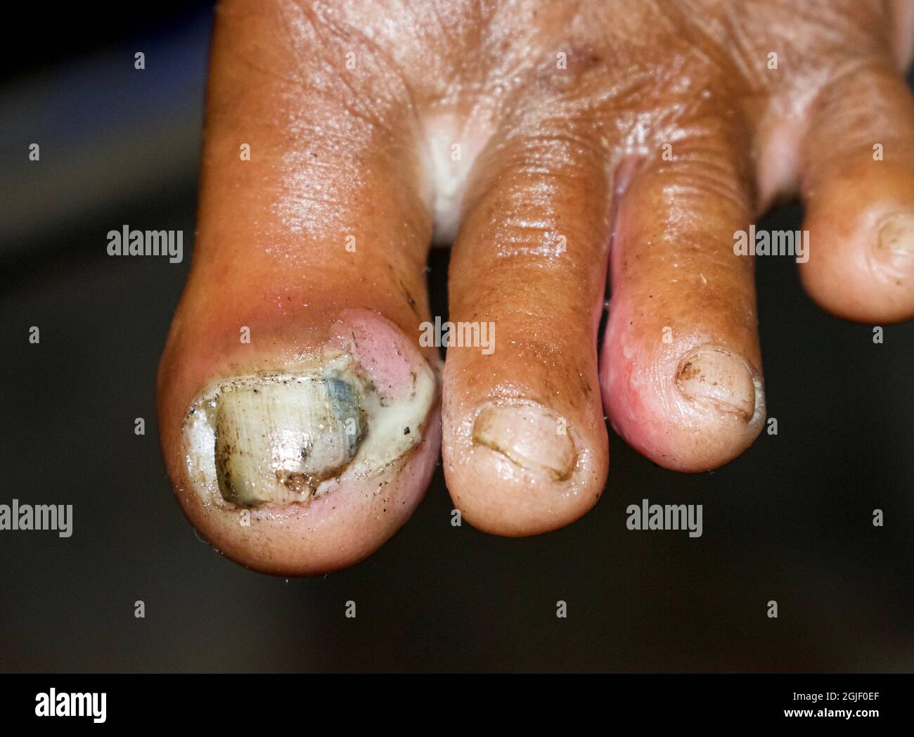 Fungal infection called tinea pedis and paronychia at toes of Asian woman. It is itching lesion. Stock Photo