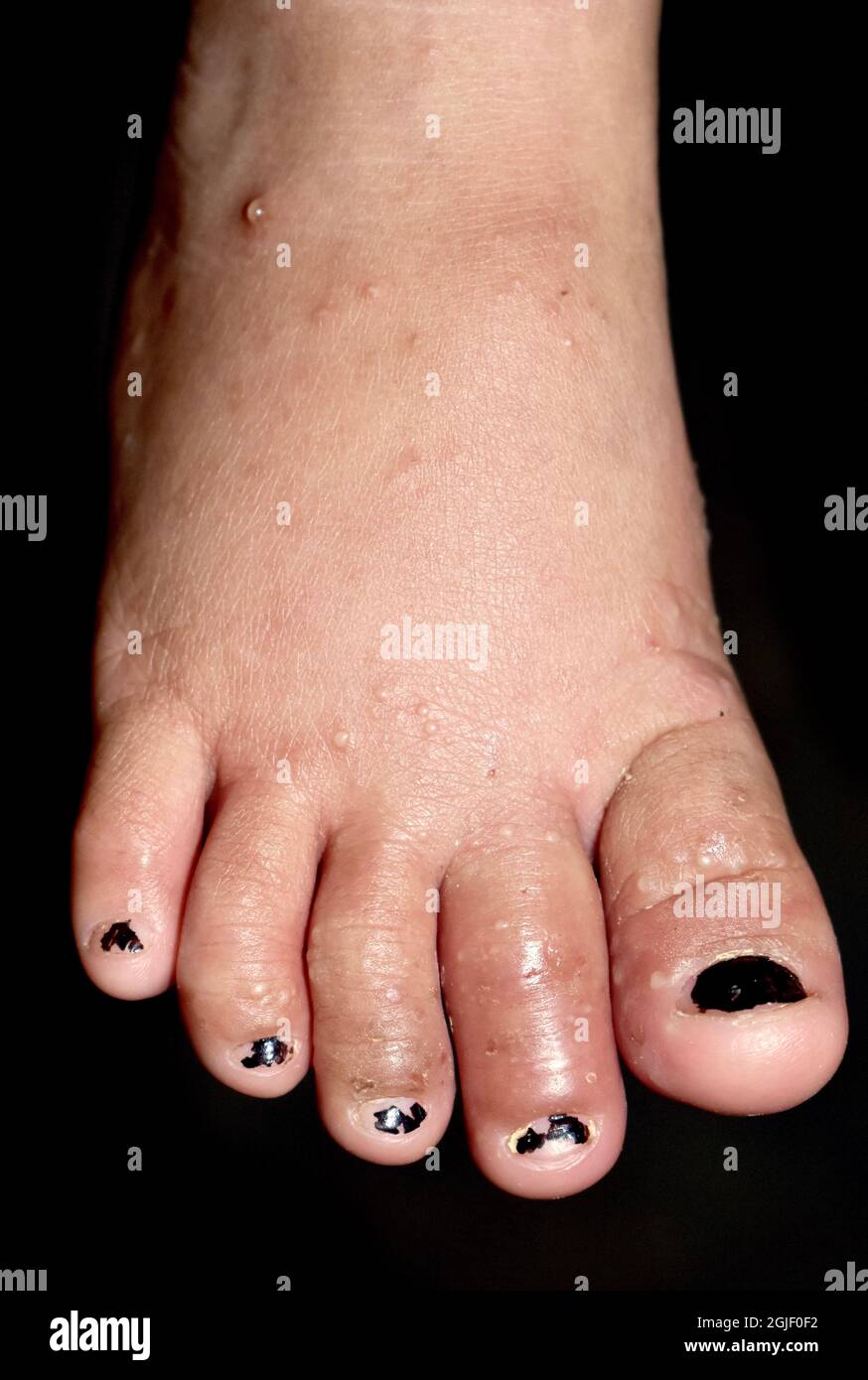 Scabies Infestation with blisters in foot of Southeast Asian, Burmese child. A contagious skin condition caused by mites. Isolated on black. Stock Photo