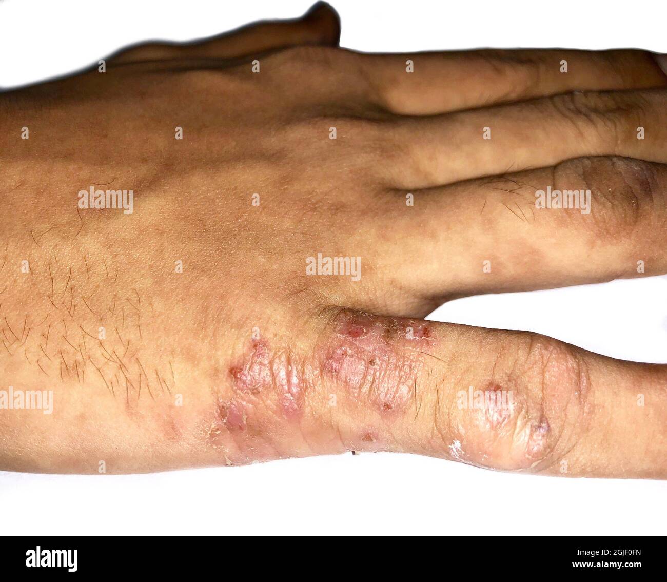 Scabies Infestation with secondary or superimposed bacterial infection in hand of Southeast Asian, Burmese child. A contagious skin condition caused b Stock Photo