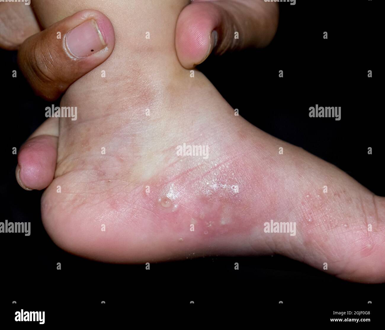 Scabies Infestation with secondary or superimposed bacterial infection and pustules in foot of Southeast Asian, Burmese child. A contagious skin condi Stock Photo