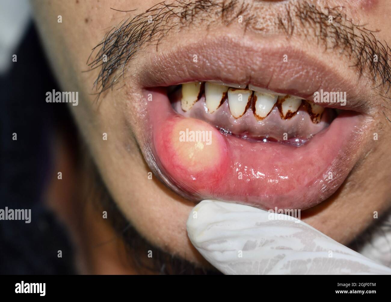 Abscess or cyst with pus at lower lip of Asian man. Stock Photo