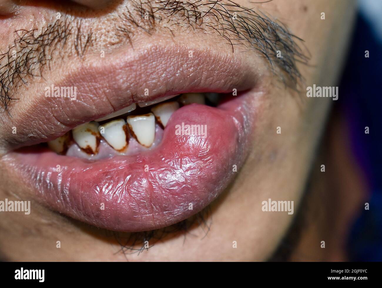 Abscess or cyst with pus at lower lip of Asian man. Stock Photo