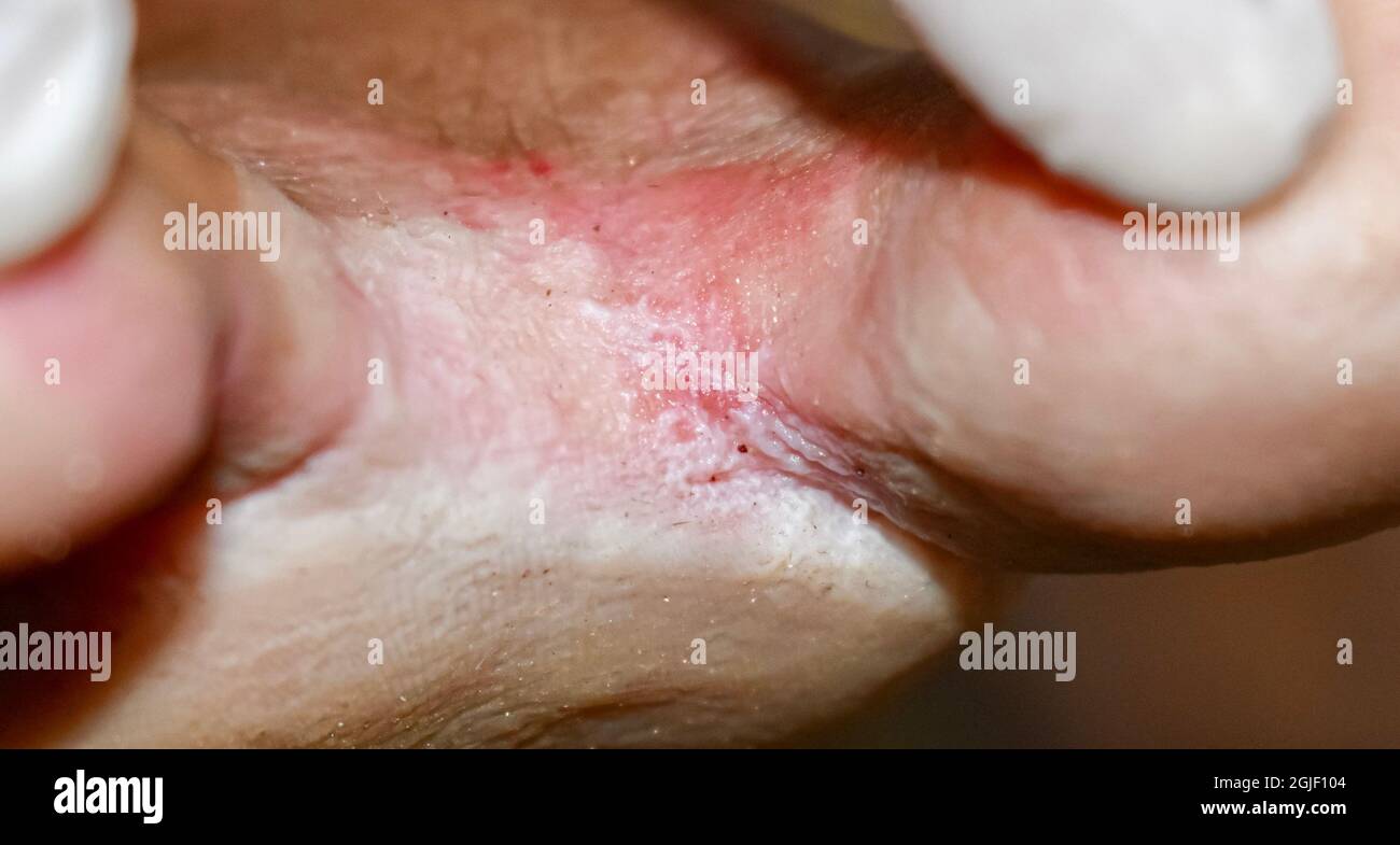 Fungal infection called tinea pedis at foot of Asian woman. It is itching lesion. Closeup view. Stock Photo