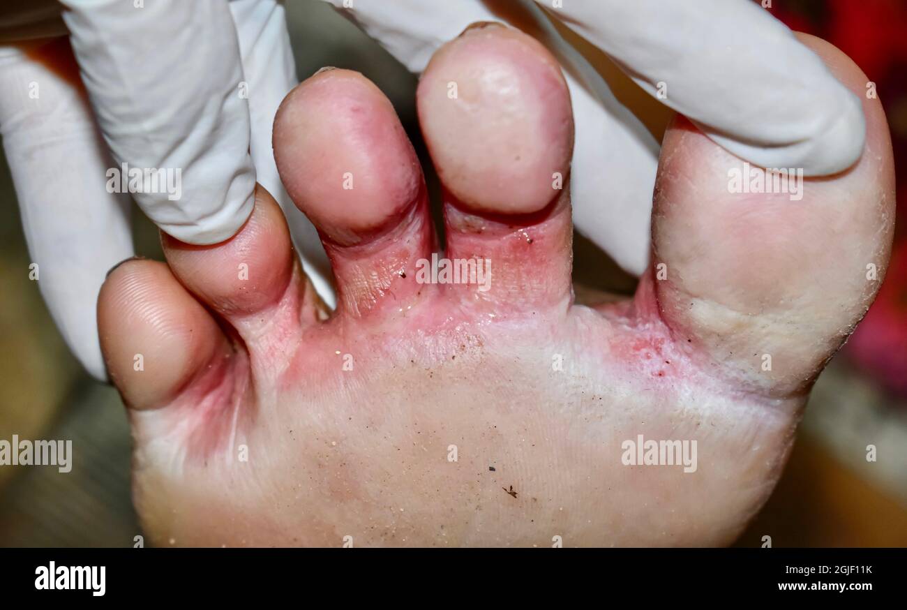 Fungal infection called tinea pedis at foot of Asian woman. It is itching lesion. Stock Photo