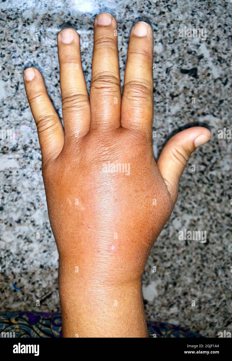 Unilateral edema of upper limb. Swollen hand and arm of Asian woman. Closeup view. Stock Photo