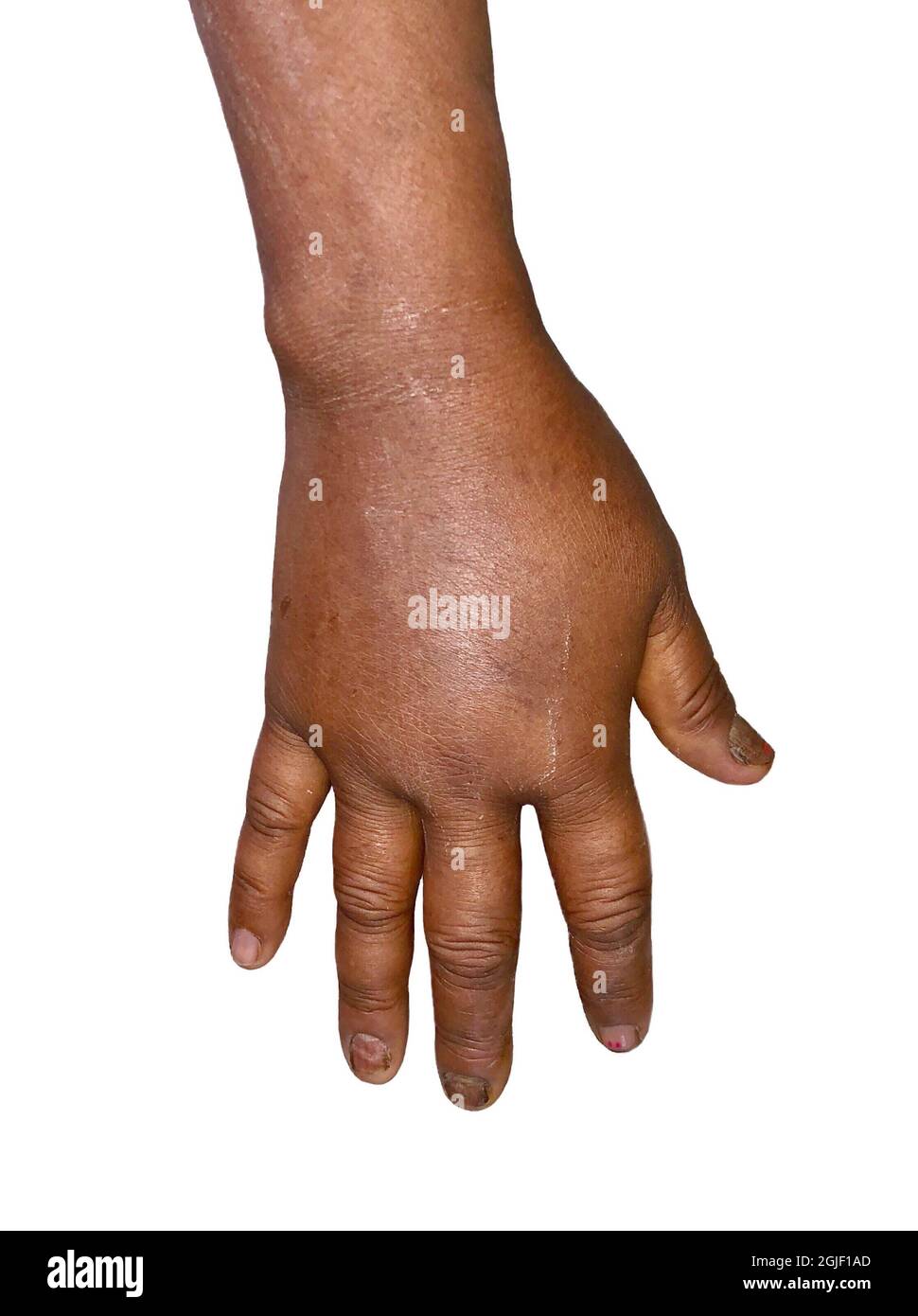 Unilateral edema of upper limb. Swollen hand and arm of Asian woman. Closeup view. Stock Photo