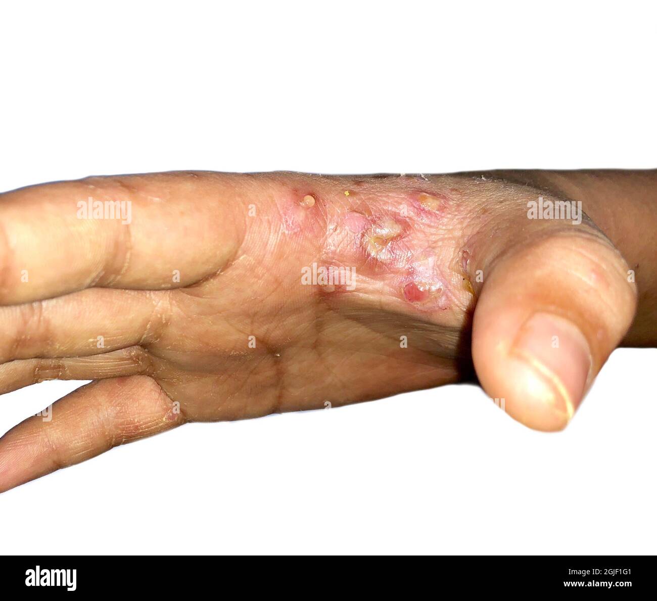 Scabies Infestation with secondary or superimposed bacterial infection and pustules in hand of Southeast Asian, Burmese child. A contagious skin condi Stock Photo