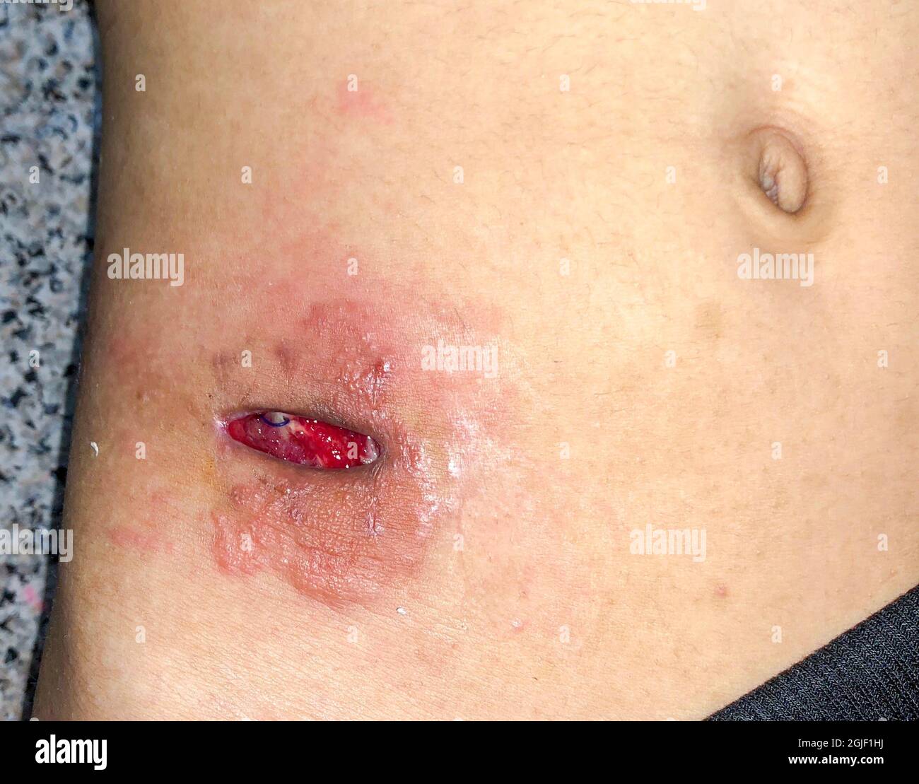 Poor wound healing due to wound gapping. Incision for appendectomy. Top view. Stock Photo