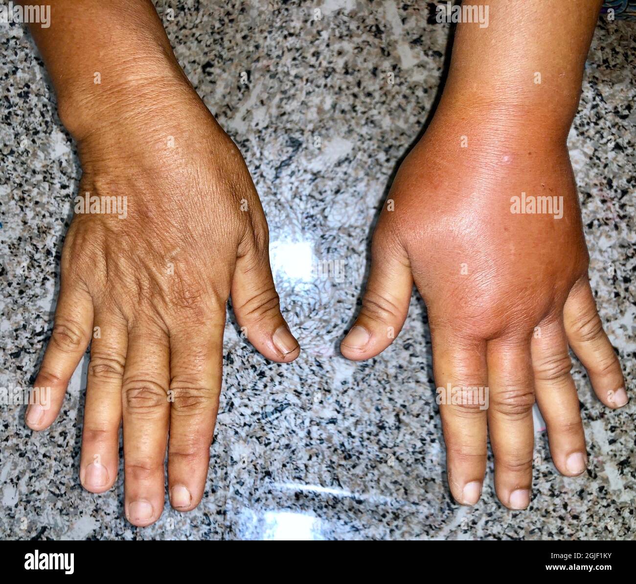 Unilateral edema of upper limb. Swollen hand and arm of Asian woman. Compared to normal forearm. Stock Photo