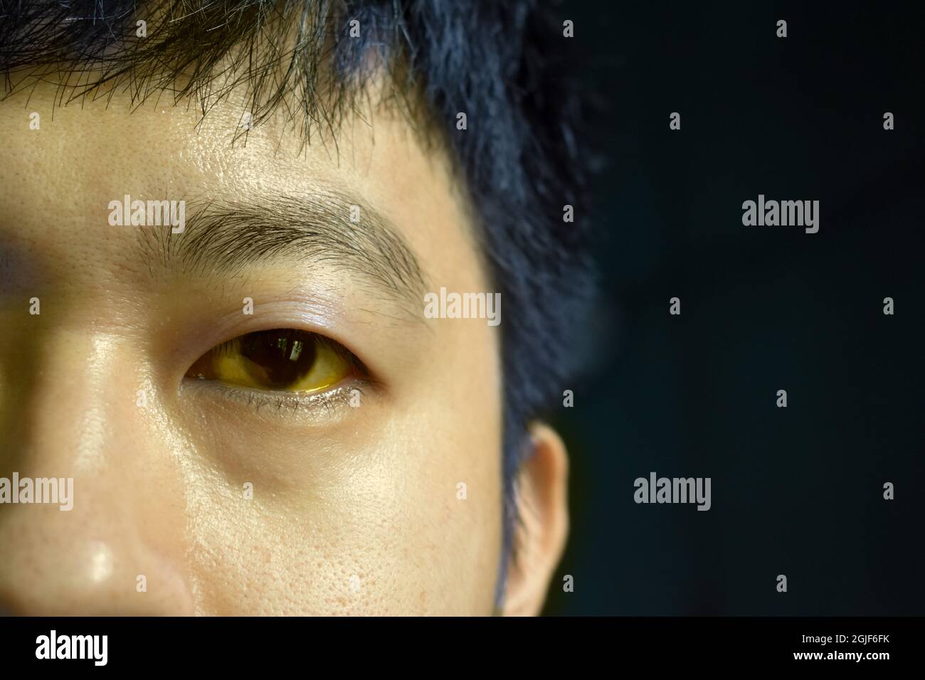 Deep jaundice in Asian male patient. Yellowish discoloration of skin and sclera. Hyperbilirubinemia. Acute hepatitis. Stock Photo