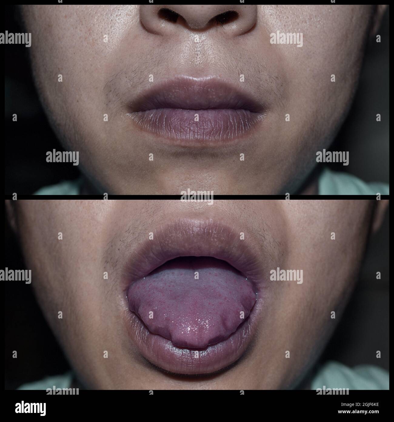 Cyanotic lips or central cyanosis at Southeast Asian, Chinese young man with COVID-19 disease. Front view. Stock Photo
