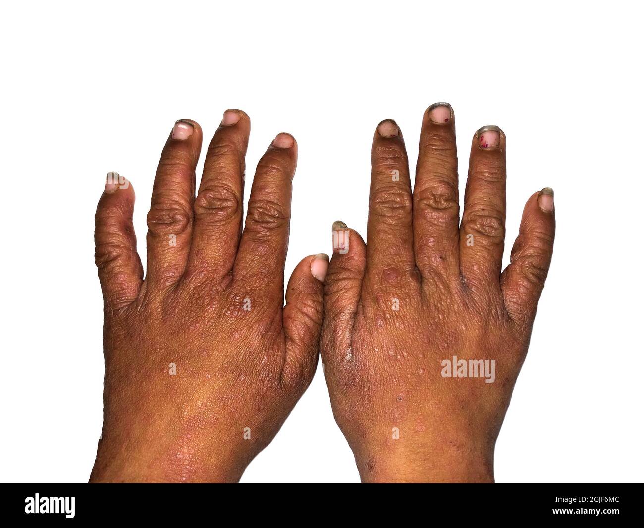 Scabies Infestation in hands of Southeast Asian, Burmese child. Rough and dirty hands. Isolated on white. Stock Photo