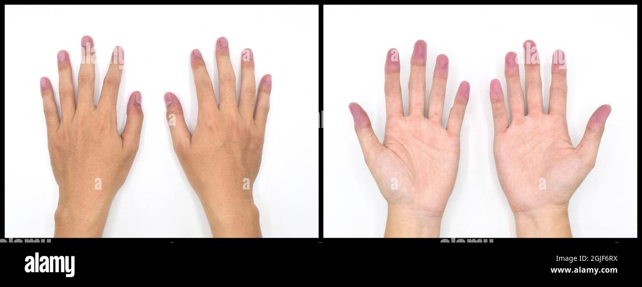 Человеческая ладонь. Закладка в изоленте. Посиневшие ногти на руках причина. Синяя рука. Почему рука становится синей.