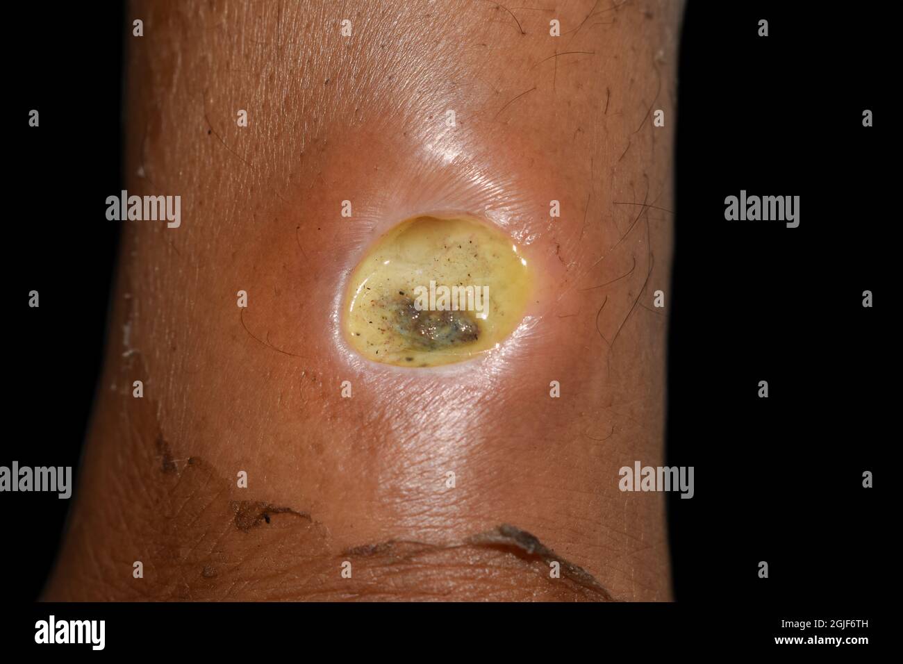 Diabetic ulcer in leg of Asian. patient. Poor wound healing. Isolated on black. Stock Photo