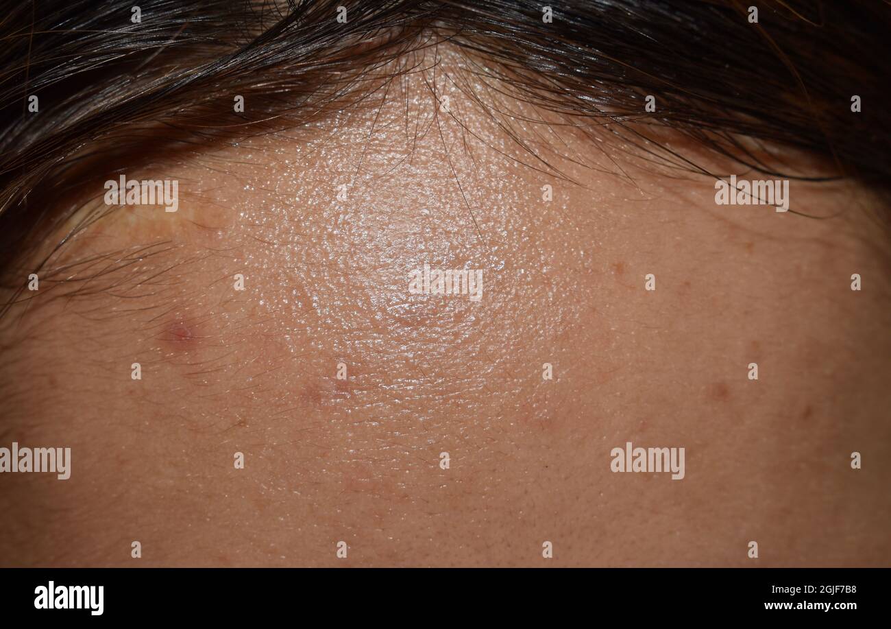 Oily skin with wide forehead of Southeast Asian, Myanmar or Korean adult  young woman. Closeup view Stock Photo - Alamy