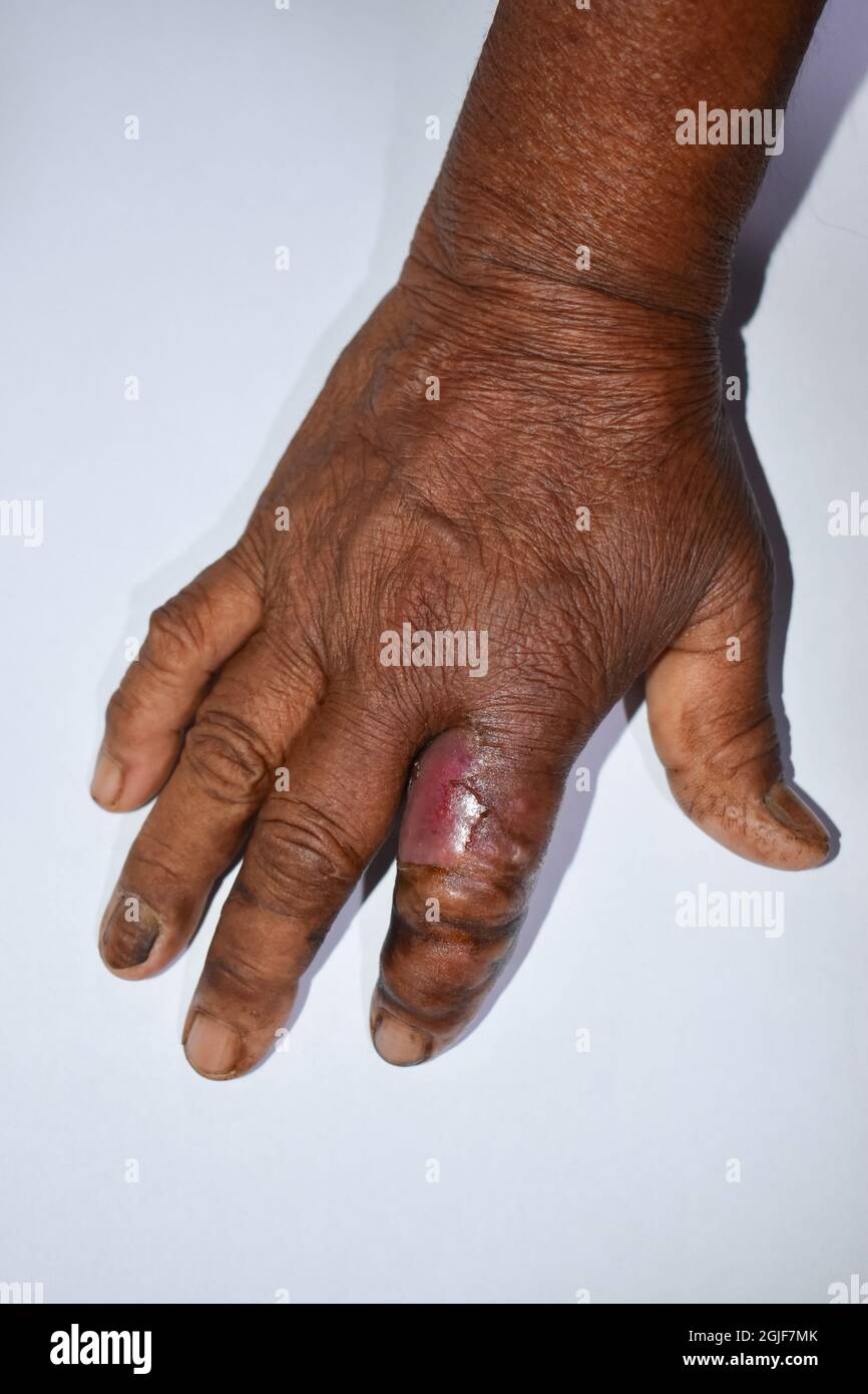 Cellulitis or Staphylococcal, Streptococcal skin infection at pointing finger of Asian Burmese female patient. Swollen and painful finger. Stock Photo
