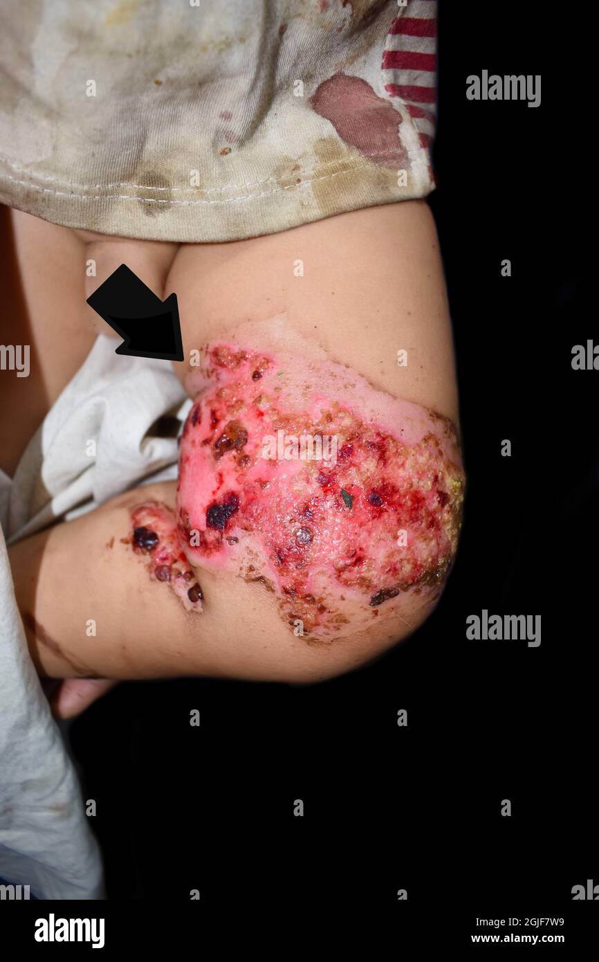 Burn wound surrounded by scabs and exsudates in thigh of Southeast Asian child. Closeup view. Stock Photo