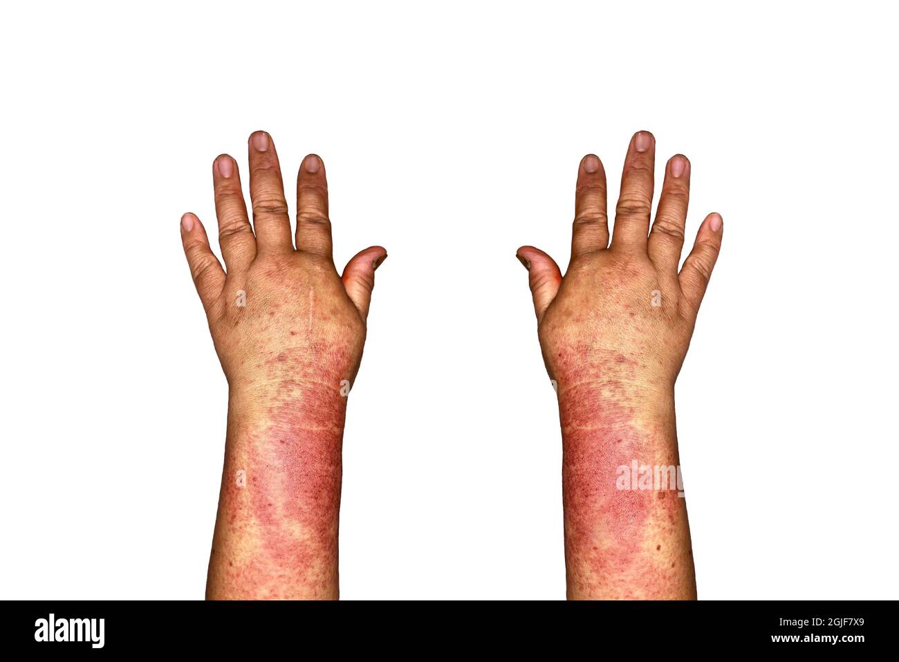 Bilateral edema of upper limbs. Swollen hands and arms of Asian woman. Isolated on white. Stock Photo