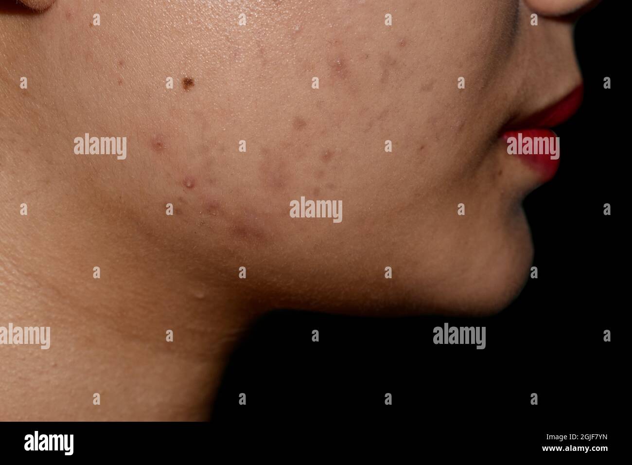 Chloasma or melasma , black spots and acne scars on face of Asian young woman. Closeup view