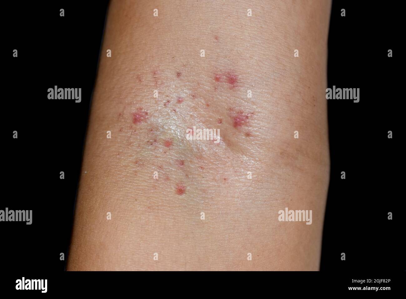Group of Small red spots or petechiae at cubital fossa area of forearm in Asian boy. Hess test or tourniquet test is positive and at least Grade 1 of Stock Photo