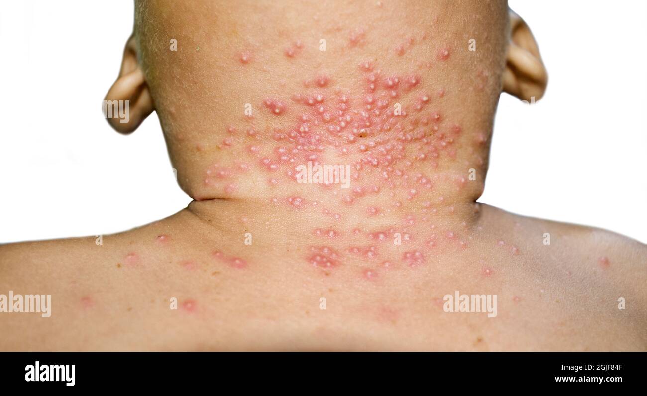 papules-skin