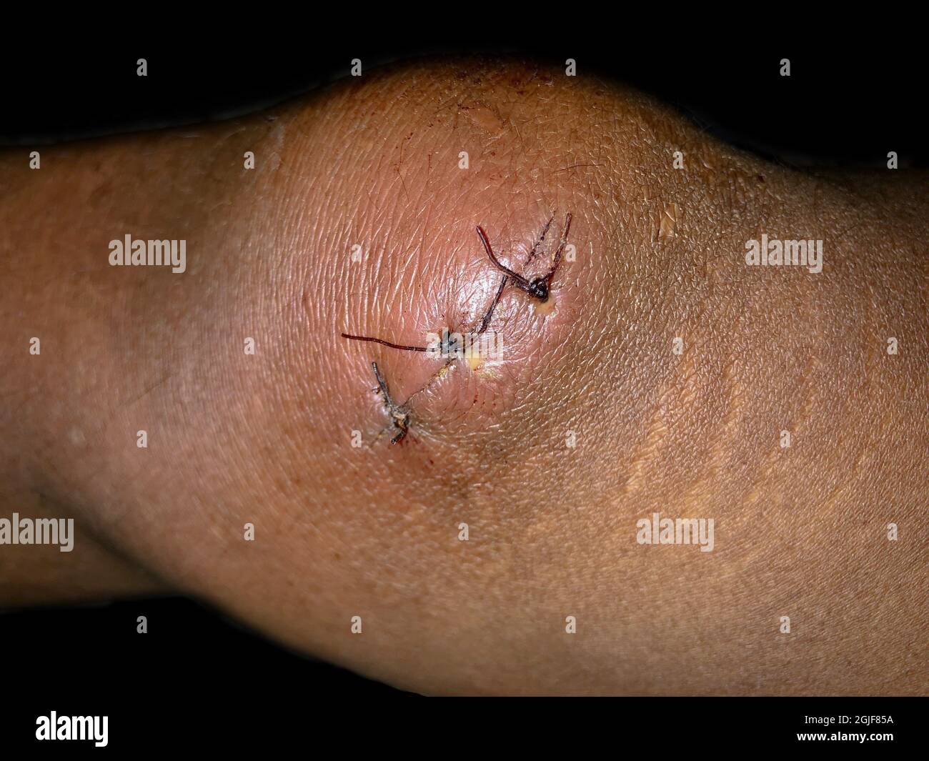Stitched lacerated wound at knee area of Southeast Asian man. Isolated on black. Stock Photo