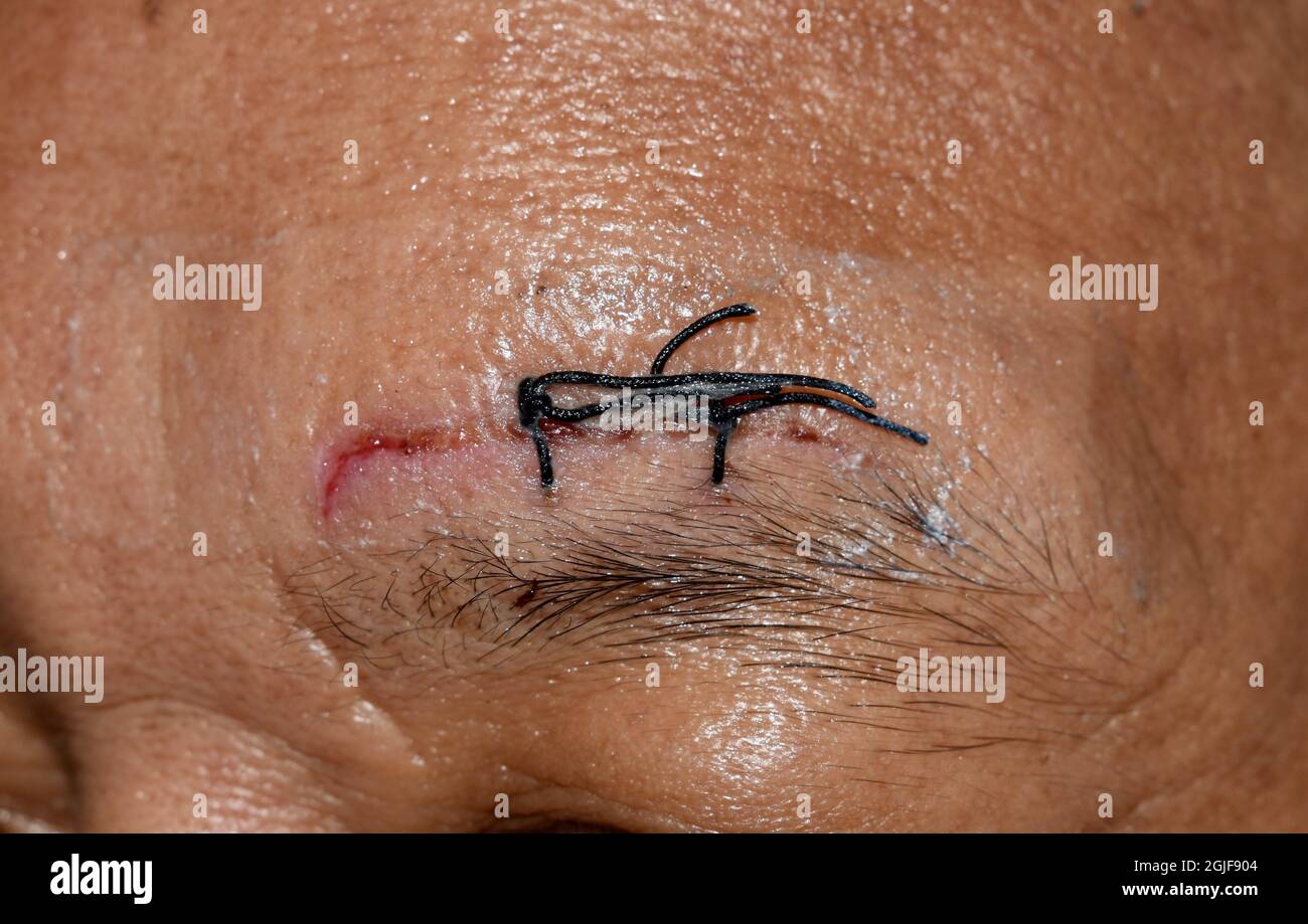 Stitched wound and abrasions  in forehead area of Southeast Asian man. Stock Photo