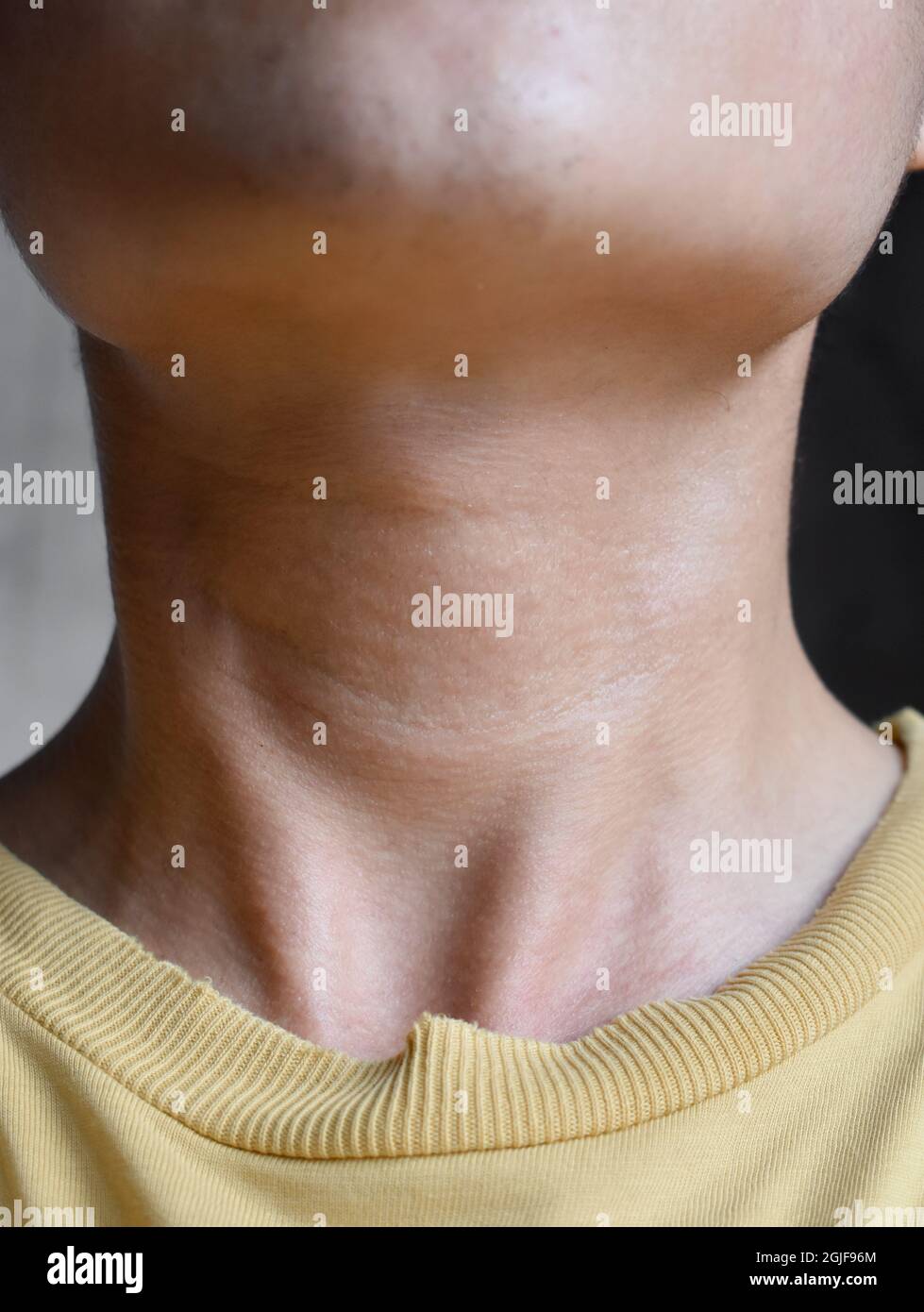 Neck swelling diagnosed as hyperthyroidism. Aging skin folds or skin creases or wrinkles at neck of Asian, Chinese young man. Front view. Stock Photo