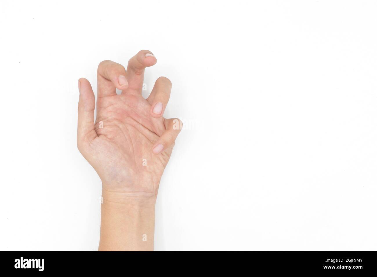 Hand muscle spasm in Asian young man. Unilateral hand deformity. Abnormal fingers flexion. Isolated on white background. Text space present. Stock Photo