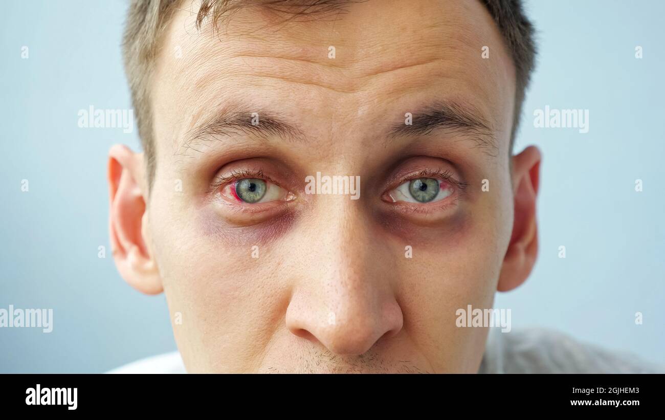 young man with red eyes looking at the camera Stock Photo Alamy