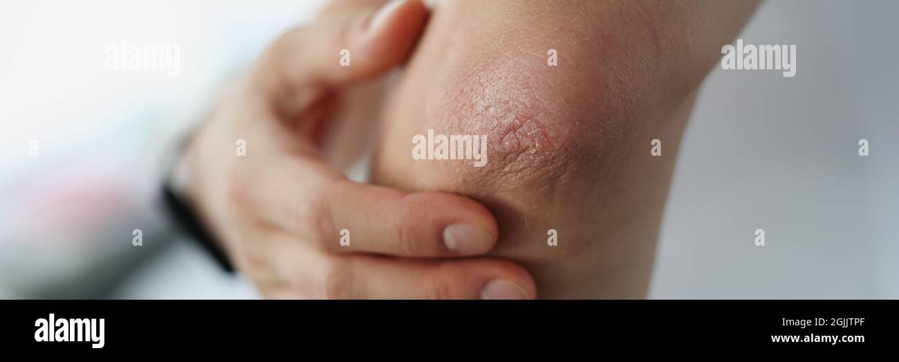 Eczema skin rash elbow arm hires stock photography and images Alamy
