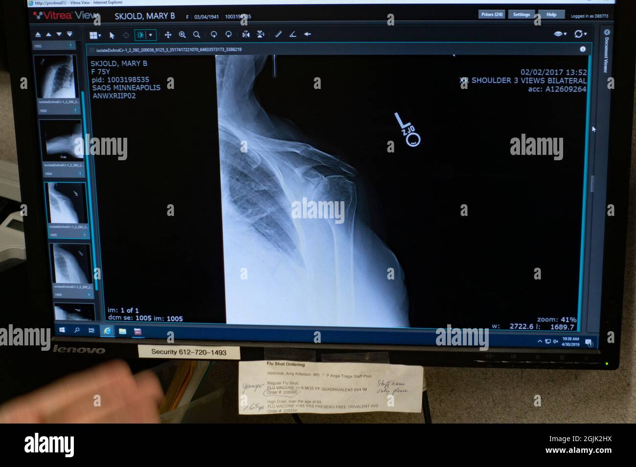 Shoulder xray of patient being examined for pain due to injury